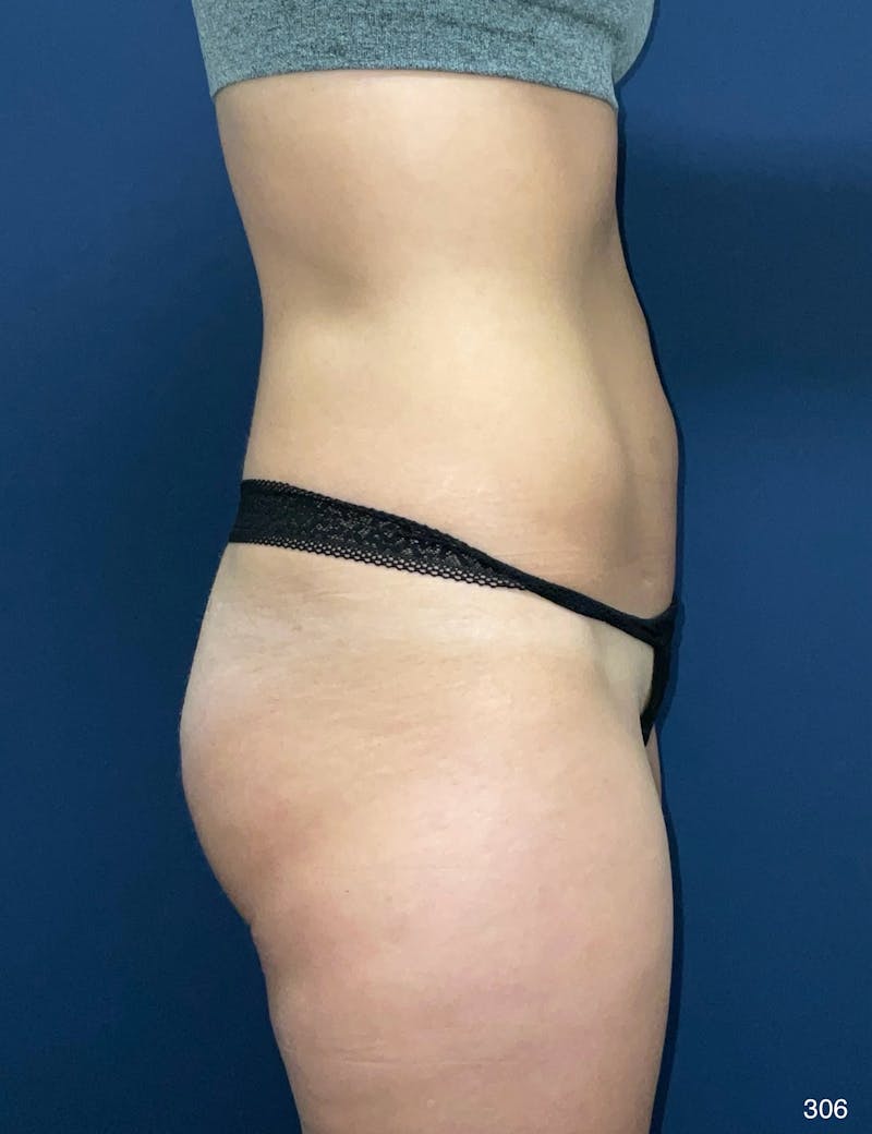 Liposuction Before & After Gallery - Patient 119273 - Image 6
