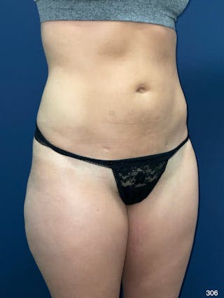 Liposuction Before & After Gallery - Patient 119273 - Image 8