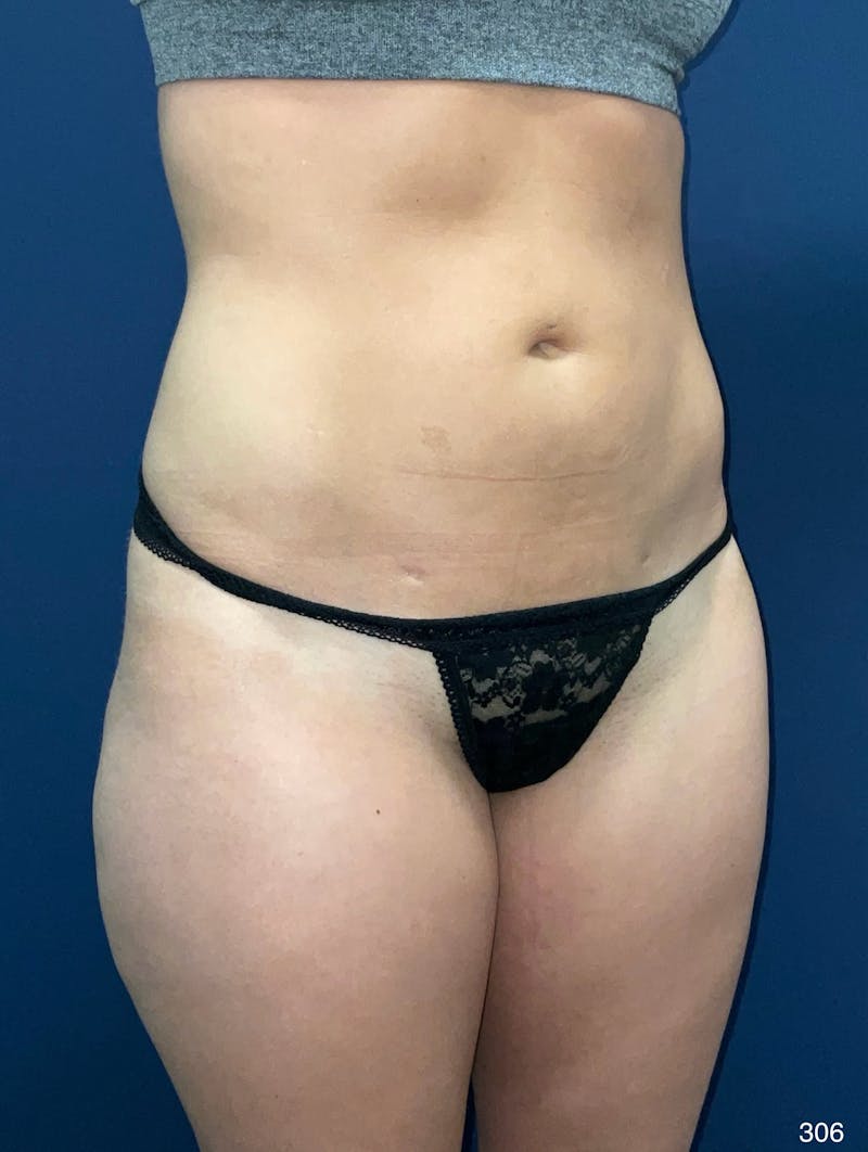 Liposuction Before & After Gallery - Patient 119273 - Image 8