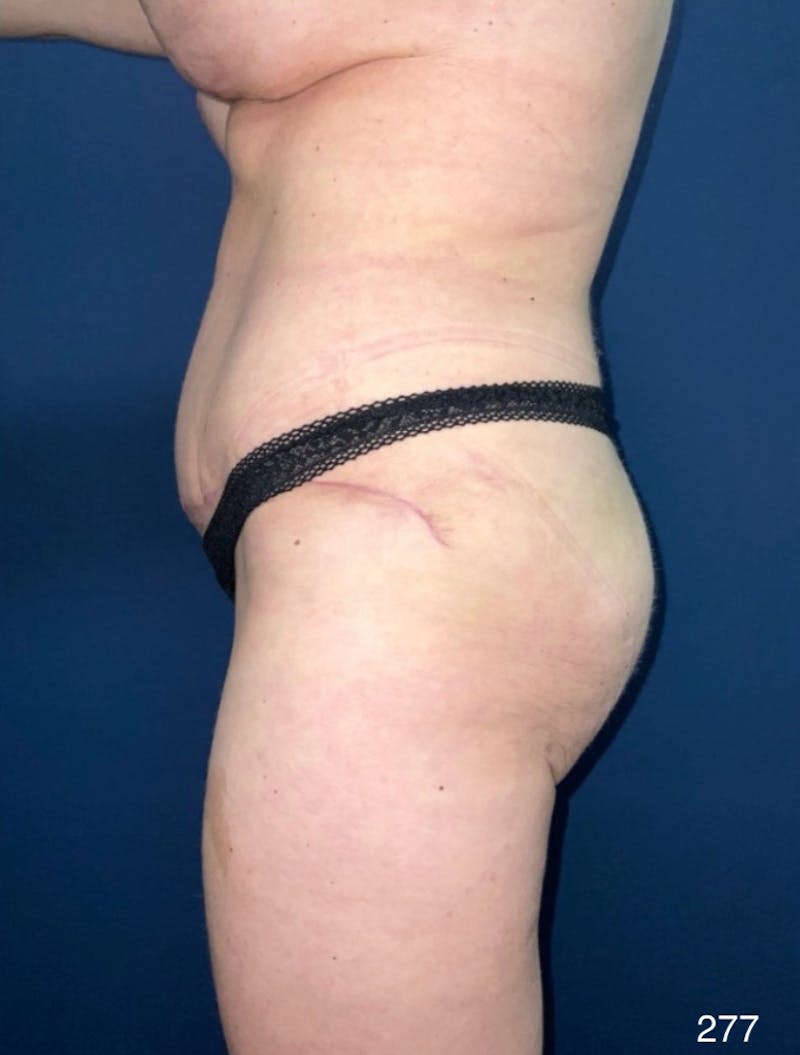 Tummy Tuck Before & After Gallery - Patient 983191 - Image 3