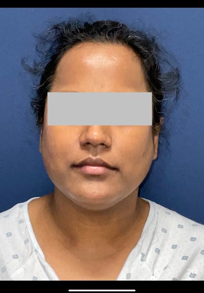 MyEllevate Before & After Gallery - Patient 132034 - Image 1