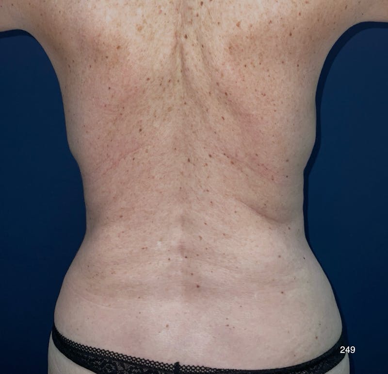BodyTite/MorpheusBody Before & After Gallery - Patient 233457 - Image 8