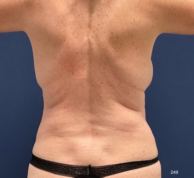 BodyTite/MorpheusBody Before & After Gallery - Patient 233457 - Image 7