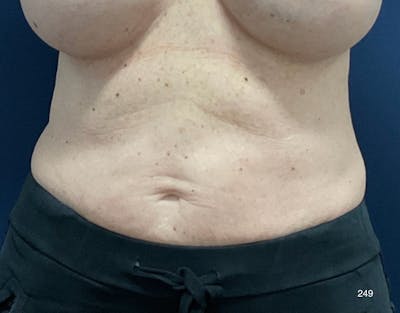 BodyTite/MorpheusBody Before & After Gallery - Patient 233457 - Image 1