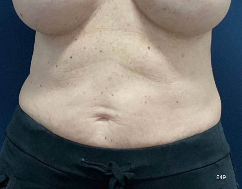 BodyTite/MorpheusBody Before & After Gallery - Patient 233457 - Image 1