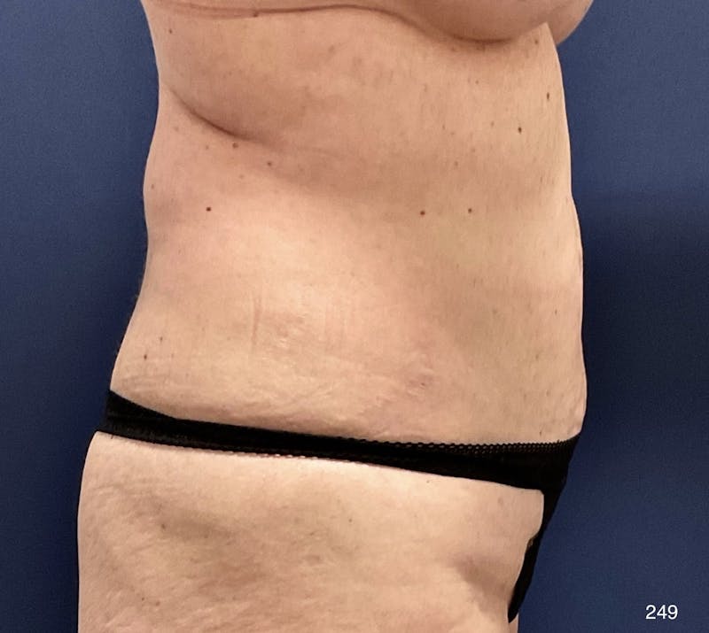 BodyTite/MorpheusBody Before & After Gallery - Patient 233457 - Image 5