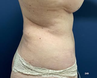 BodyTite/MorpheusBody Before & After Gallery - Patient 233457 - Image 6