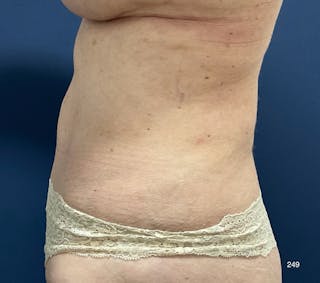 BodyTite/MorpheusBody Before & After Gallery - Patient 233457 - Image 4