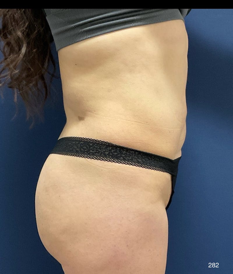 Tummy Tuck Before & After Gallery - Patient 357610 - Image 3