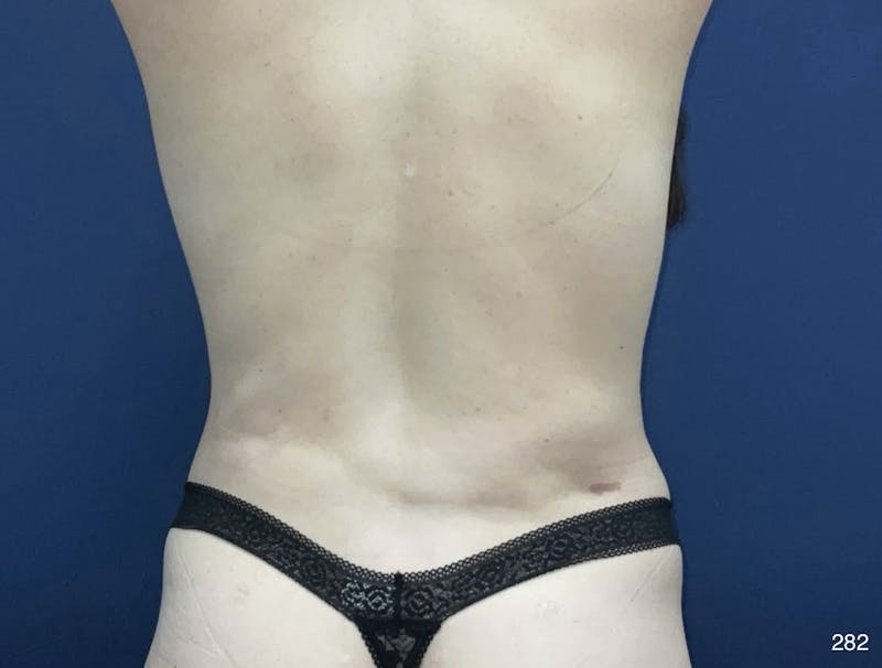 Tummy Tuck Before & After Gallery - Patient 357610 - Image 6