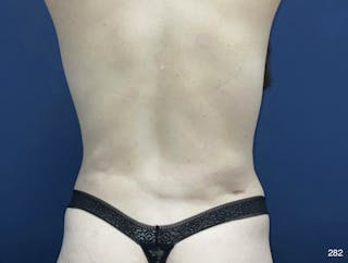 Tummy Tuck Before & After Gallery - Patient 357610 - Image 6