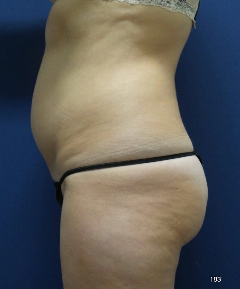 Tummy Tuck Before & After Gallery - Patient 158195 - Image 5
