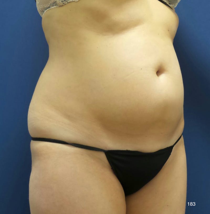 Tummy Tuck Before & After Gallery - Patient 158195 - Image 3