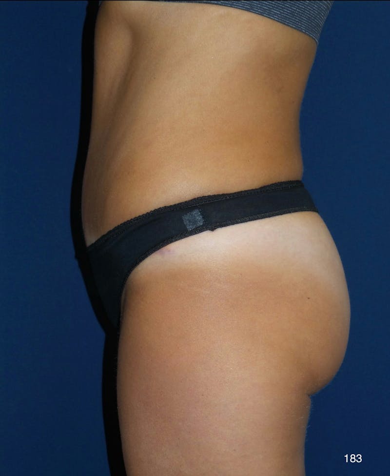 Tummy Tuck Before & After Gallery - Patient 158195 - Image 6