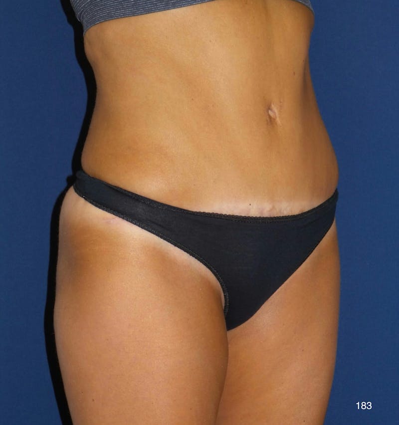 Tummy Tuck Before & After Gallery - Patient 158195 - Image 4