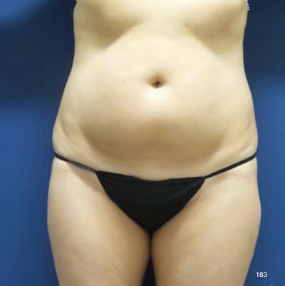 Tummy Tuck Before & After Gallery - Patient 158195 - Image 1