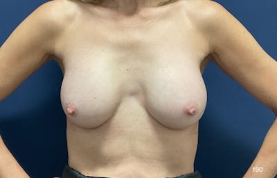 Capsulectomy Implant Exchange Before & After Gallery - Patient 162039 - Image 1