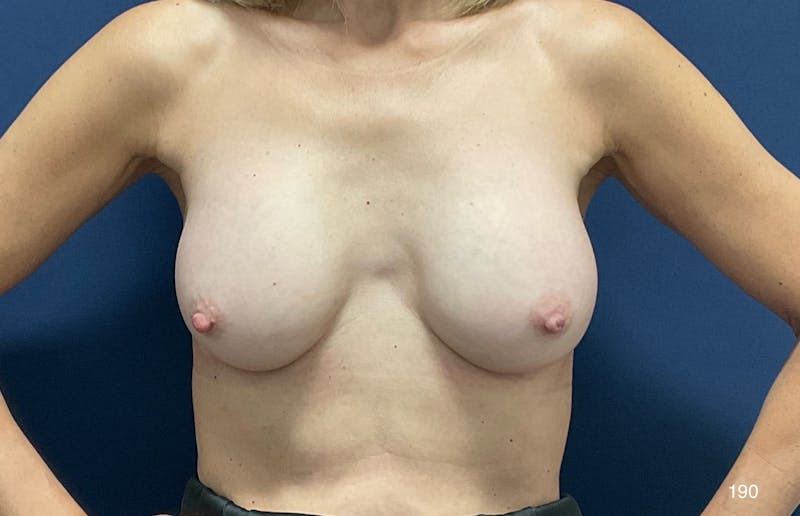 Capsulectomy Implant Exchange Before & After Gallery - Patient 162039 - Image 1