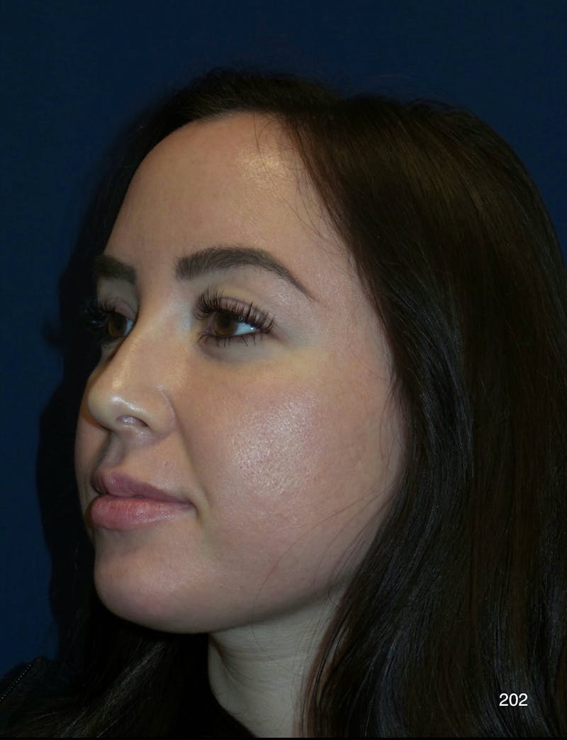 Buccal Fat Pad Removal Before & After Gallery - Patient 301697 - Image 3