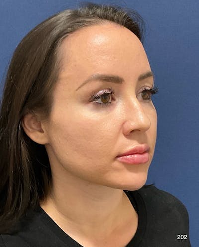 Buccal Fat Pad Removal Before & After Gallery - Patient 301697 - Image 2