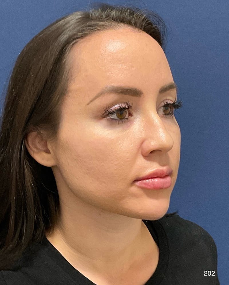Buccal Fat Pad Removal Before & After Gallery - Patient 301697 - Image 2