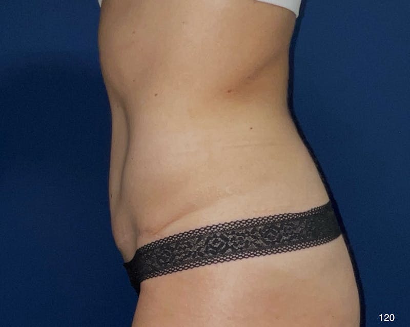 Tummy Tuck Before & After Gallery - Patient 403822 - Image 4