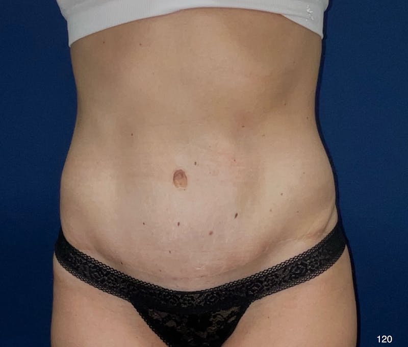 Tummy Tuck Before & After Gallery - Patient 403822 - Image 2