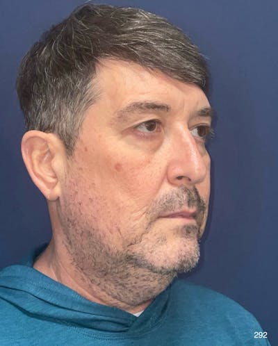 Neck Lift Before & After Gallery - Patient 412157 - Image 1