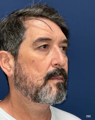 Neck Lift Before & After Gallery - Patient 412157 - Image 2