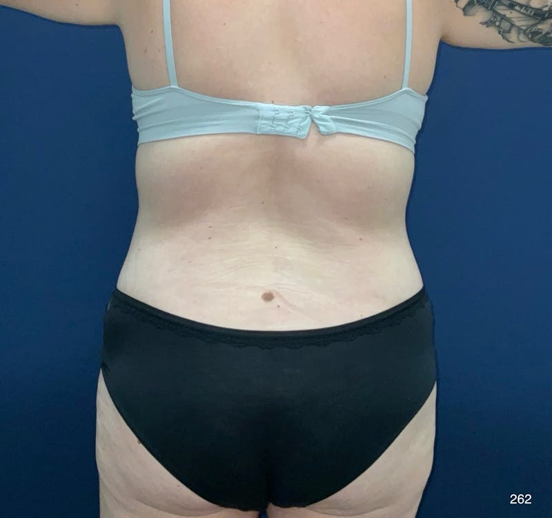 Tummy Tuck Before & After Gallery - Patient 208718 - Image 6