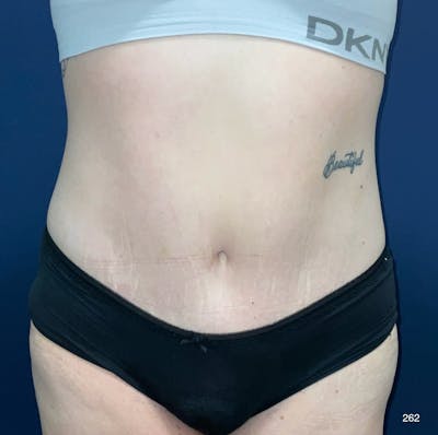 Tummy Tuck Before & After Gallery - Patient 208718 - Image 2