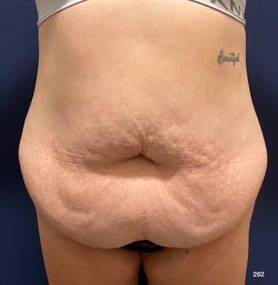 Tummy Tuck Before & After Gallery - Patient 208718 - Image 1