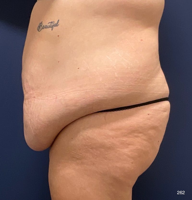 Tummy Tuck Before & After Gallery - Patient 208718 - Image 4