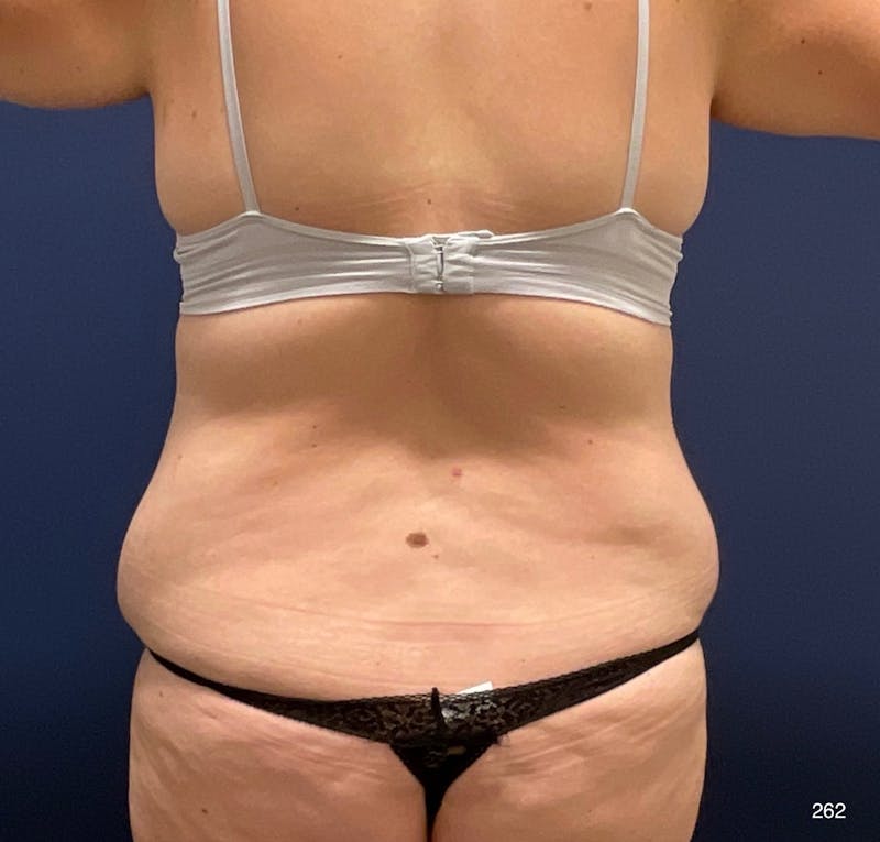Tummy Tuck Before & After Gallery - Patient 208718 - Image 5