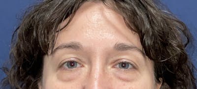 Blepharoplasty Before & After Gallery - Patient 195035 - Image 1