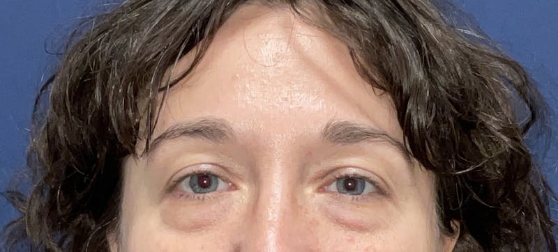 Blepharoplasty Before & After Gallery - Patient 195035 - Image 1