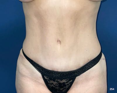 Tummy Tuck Before & After Gallery - Patient 121005 - Image 2