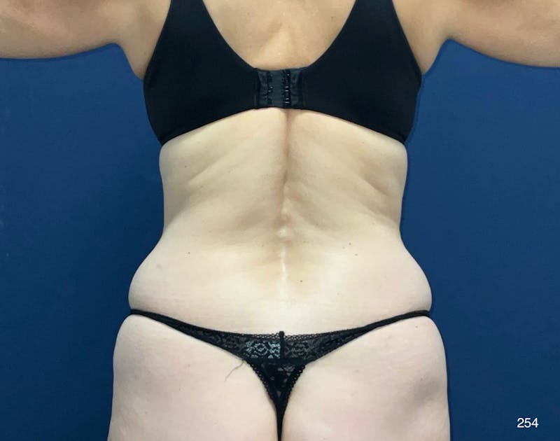 Tummy Tuck Before & After Gallery - Patient 121005 - Image 5