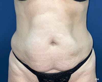 Tummy Tuck Before & After Gallery - Patient 121005 - Image 1