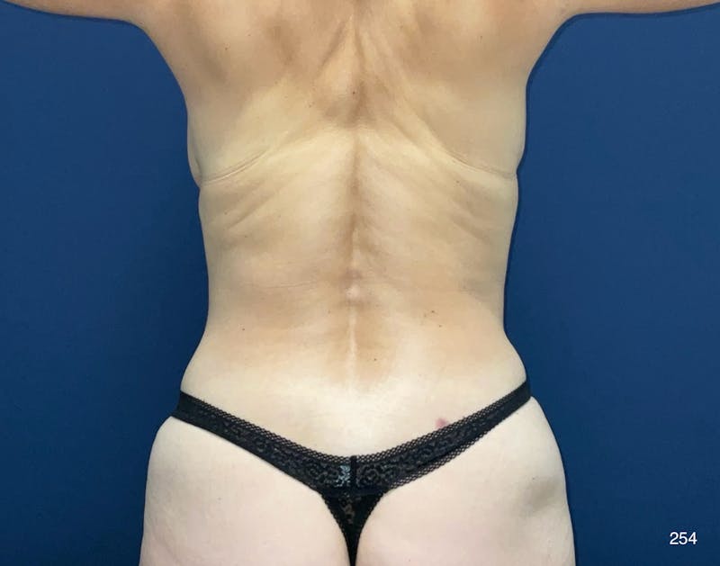 Tummy Tuck Before & After Gallery - Patient 121005 - Image 6