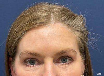 Blepharoplasty Before & After Gallery - Patient 119830 - Image 1