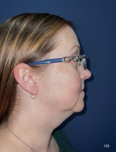 Submental Liposuction Before & After Gallery - Patient 151394 - Image 1