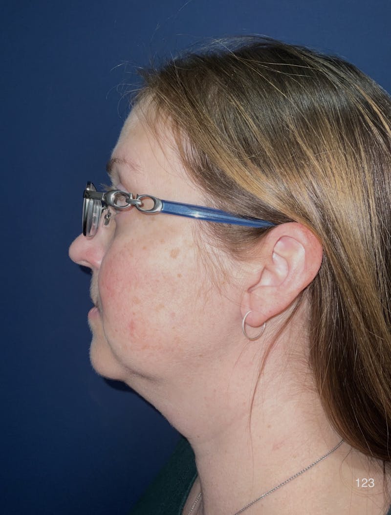 FaceTite/Morpheus8 Before & After Gallery - Patient 984114 - Image 3