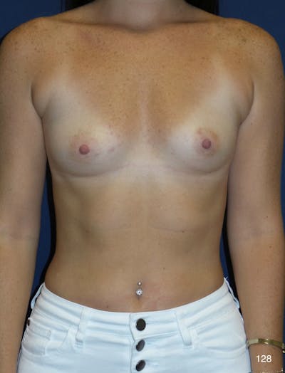 Breast Augmentation Before & After Gallery - Patient 447577 - Image 1