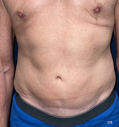 Tummy Tuck Before & After Gallery - Patient 714304 - Image 2