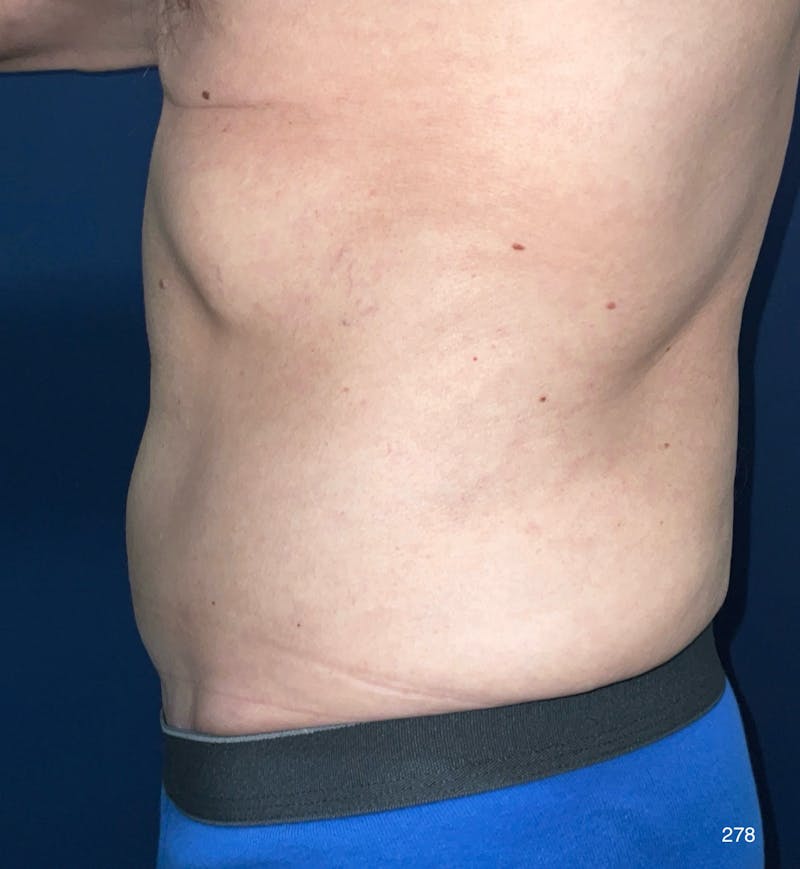 Tummy Tuck Before & After Gallery - Patient 714304 - Image 4