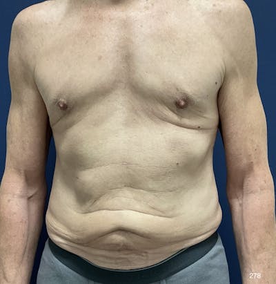 Tummy Tuck Before & After Gallery - Patient 714304 - Image 1