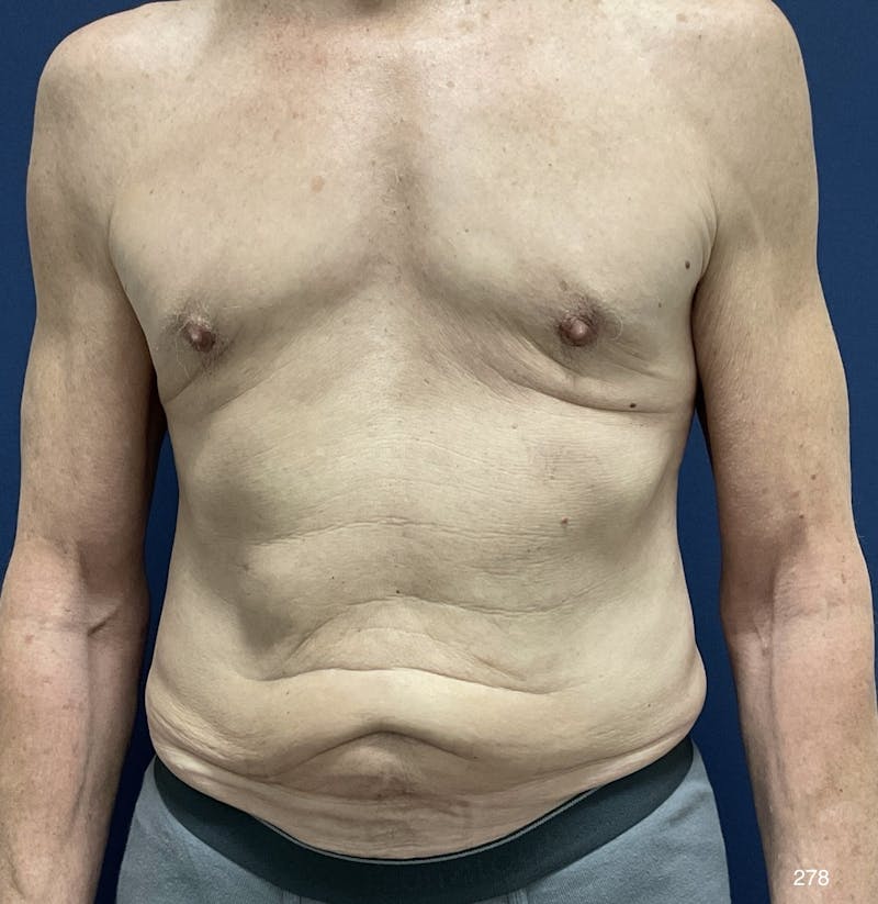 Tummy Tuck Before & After Gallery - Patient 714304 - Image 1
