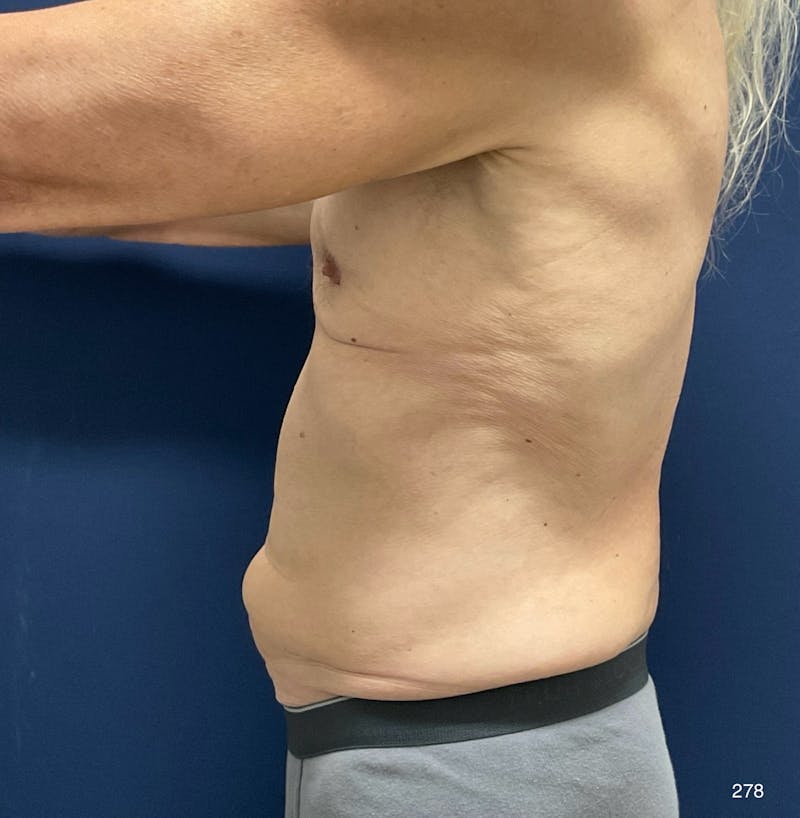 Tummy Tuck Before & After Gallery - Patient 714304 - Image 3