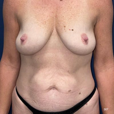 Mommy Makeover Before & After Gallery - Patient 284958 - Image 1